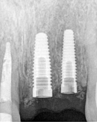 Dental Implants Yorkville