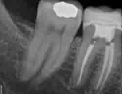 Root Canal Toronto